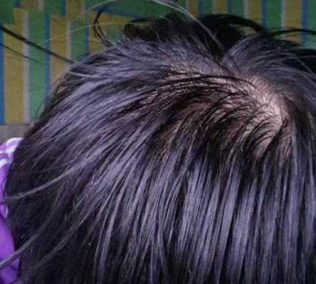 为什么有人头发油的不快,头发太油是怎么回事?