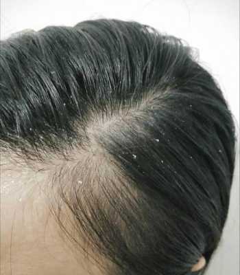 男生头皮屑多，用什么洗发水,男生头屑多是什么原因造成的