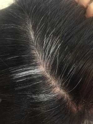 学生头发白怎么办（15岁女学生为什么会长白眉毛）