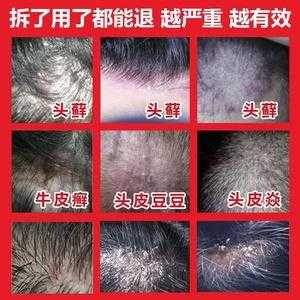 孩子头皮痒怎么治疗,秋季头皮发痒怎么办用什么药