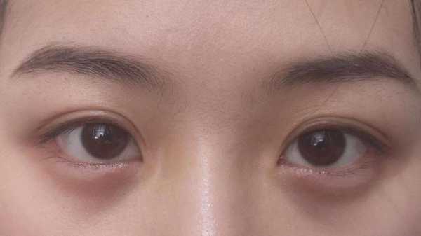下眼袋黑怎么回事,黑眼带怎么才能快速消除