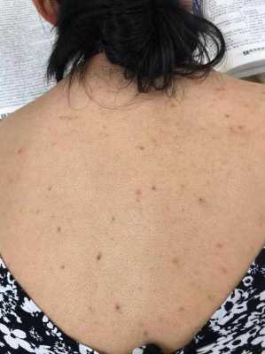 女生后背起痘痘什么原因（女生后背起痘痘什么原因引起的）