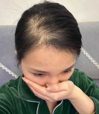 头发头顶少怎么办（头发头顶少怎么办女生）