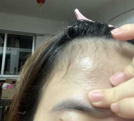 怎样永久去除额头多余毛发,额头上的头发怎么去掉小妙招