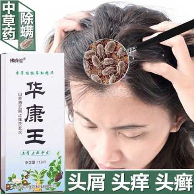 怎么去屑止痒最有效（去屑止痒最好的小妙招）