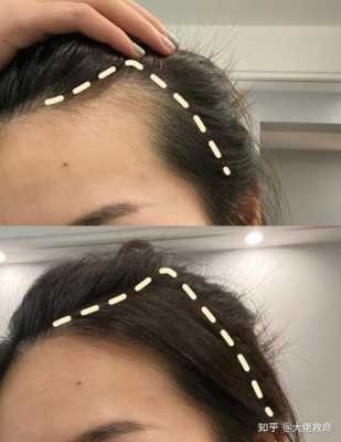 额角头发稀少怎么办（发际线秃怎么办）
