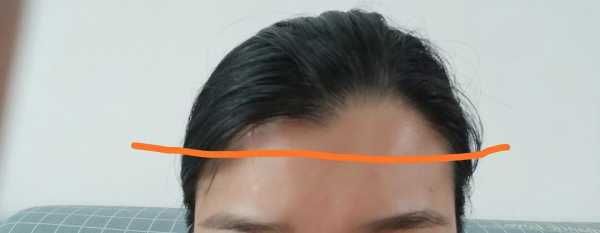 额角头发稀少怎么办（发际线秃怎么办）