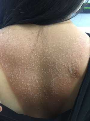 严重晒伤后怎么修复（严重晒伤后怎么修复好）