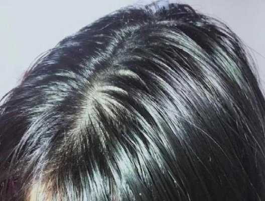 为啥头发总是发根油得很,头发好出油是什么原因引起的