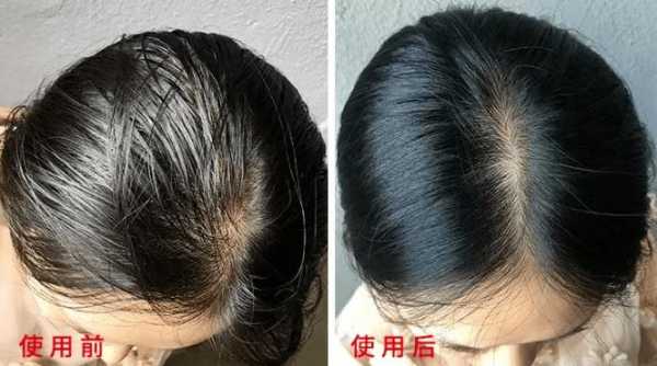 头发油掉发是什么原因（头皮发红，头发脱落）