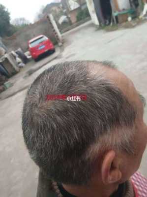 吃什么东西头发能变黑（最近有少许白发，吃阿胶有助于头发变黑）