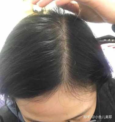 头发生长快是什么原因（男生的头发为什么比女生的头发长得快）
