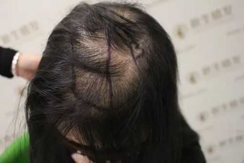 17岁女孩子掉头发好厉害是什么原因,女孩头发掉的厉害是什么原因怎么办
