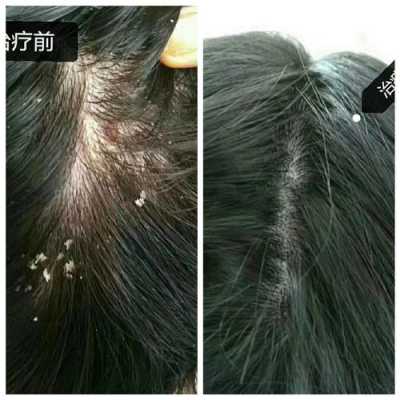接头发头皮痒怎么处理（用中药头发头皮痒怎么回事）