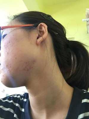 女生下巴频繁长痘怎么回事,女人下巴长痘是什么原因引起的