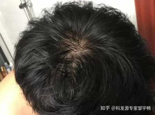 脱发是何原因,脱发一般都是什么原因造成的