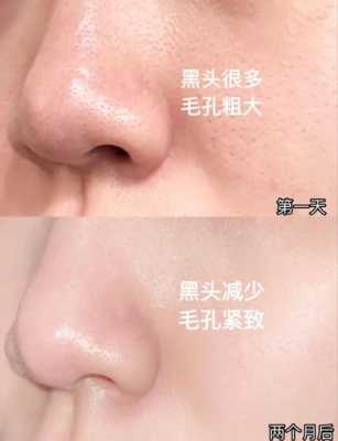 怎么样去除黑头粉刺（如何去除黑头粉刺收缩毛孔的方法）