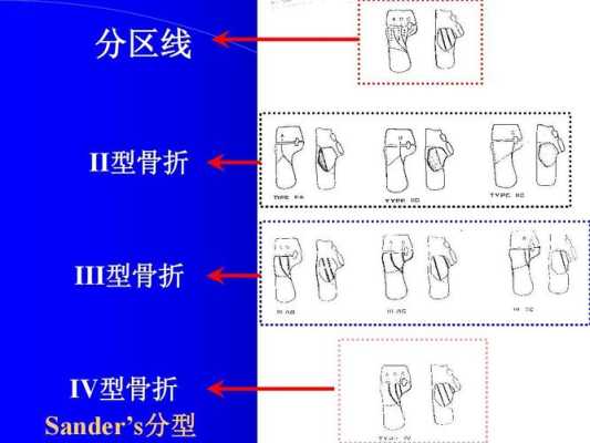 骨什么型（骨型什么意思）