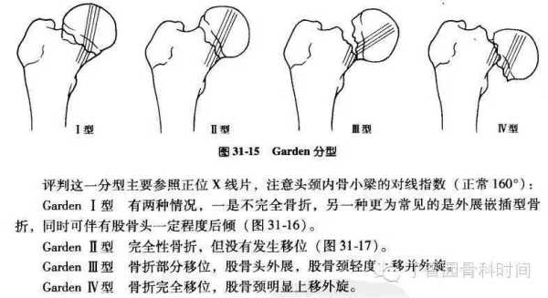骨什么型（骨型什么意思）
