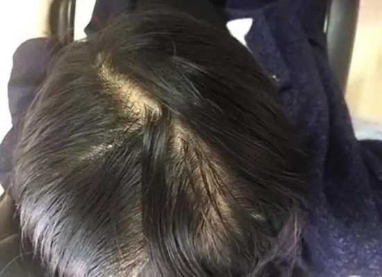 头发油腻脱发严重怎么办,头发多油脱发怎么办女性