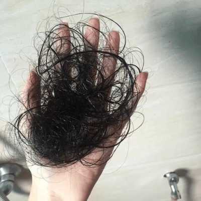 头发油腻脱发严重怎么办,头发多油脱发怎么办女性