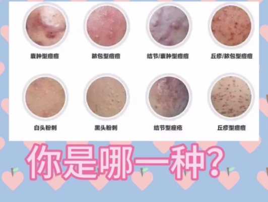 什么法痘（治疗什么样痘痘）