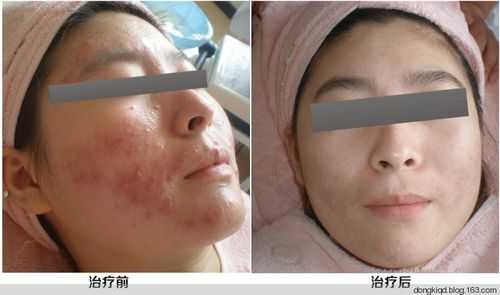 什么法痘（治疗什么样痘痘）
