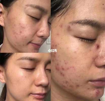 什么法痘（治疗什么样痘痘）