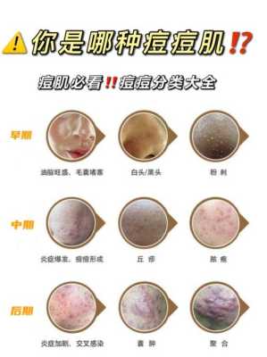 痘痘的什么（痘痘的什么）