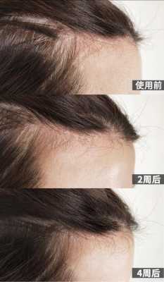 头皮敏感脱发怎么办