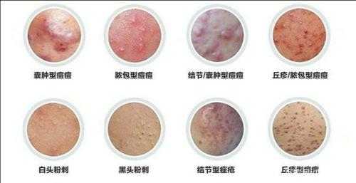 长痘属于什么（长痘属于什么皮肤病）