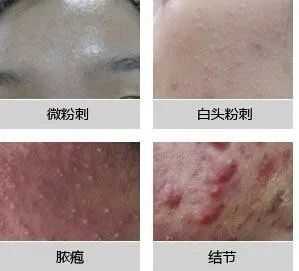 长痘属于什么（长痘属于什么皮肤病）