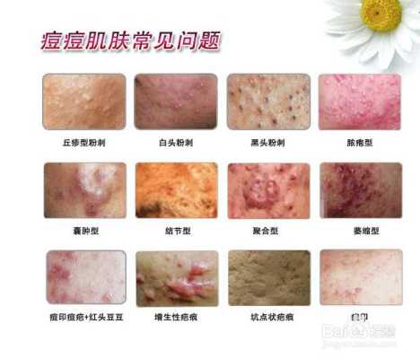 长痘属于什么（长痘属于什么皮肤病）