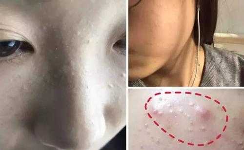 闭口粉刺长什么样,什么是粉刺
