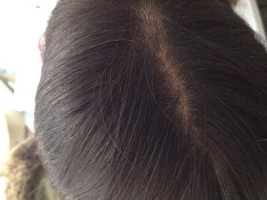 头顶少头发怎么办（头顶头发稀少怎么办）