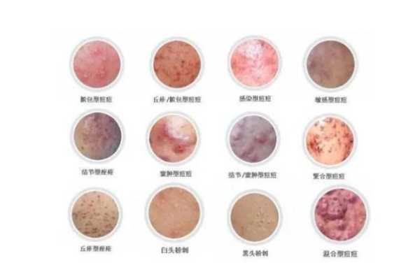 长粉刺是什么怎么消除（长粉刺怎么办怎么解决）