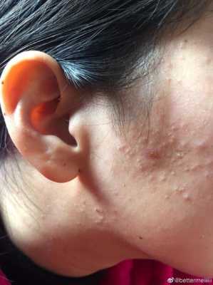 长粉刺是什么怎么消除（长粉刺怎么办怎么解决）