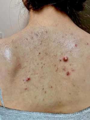 女孩背后长痘痘怎么办（背上长痘痘的解决方法）