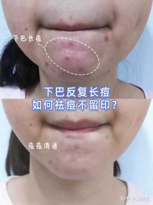 下巴上长痘怎么办（下巴上长痘怎么办啊）