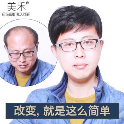 男士掉头发怎么办（男生掉头发很厉害怎么办才好）