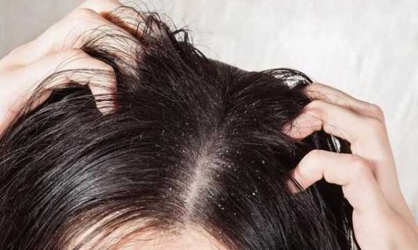 头屑多脱发严重怎么办（头屑多脱发严重怎么办女性）