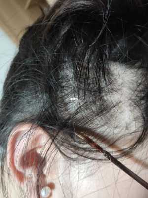 头屑多脱发严重怎么办（头屑多脱发严重怎么办女性）