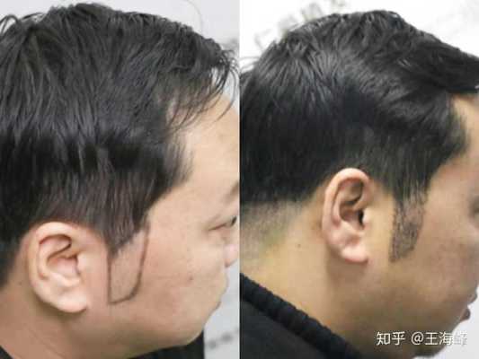 鬓角两边秃怎么拯救,秃鬓角怎么能长头发呢