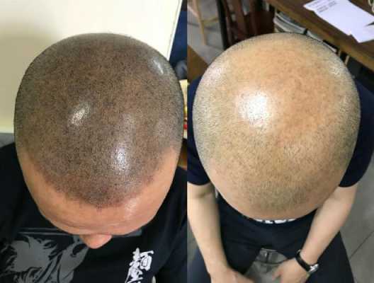 头发伤的厉害怎么办（头发太抛了怎么办）