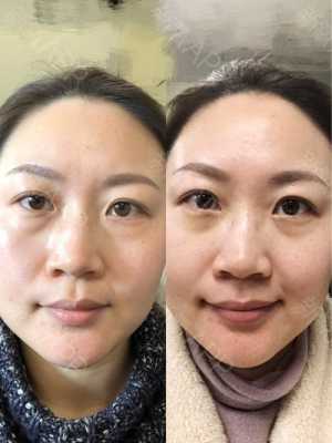 什么去眼袋效果（什么去眼袋效果最好）
