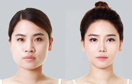 圆脸怎么办成瓜子脸（圆脸怎么整成瓜子脸）