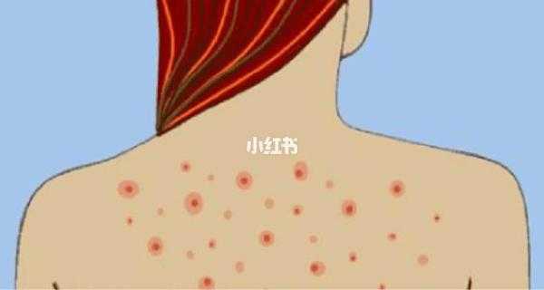 背 痘痘是什么原因（背痘痘是什么原因）