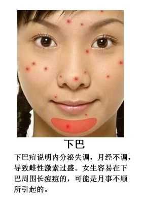下巴容易长痘痘怎么办（下巴长痘痘如何消除）
