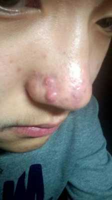 鼻子的痘怎么处理,鼻子总长痘痘怎么办啊