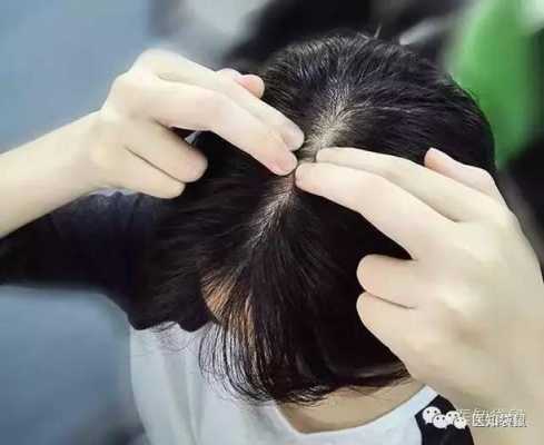 3天洗一次头掉头发50根正常吗,洗头发掉怎么办小妙招